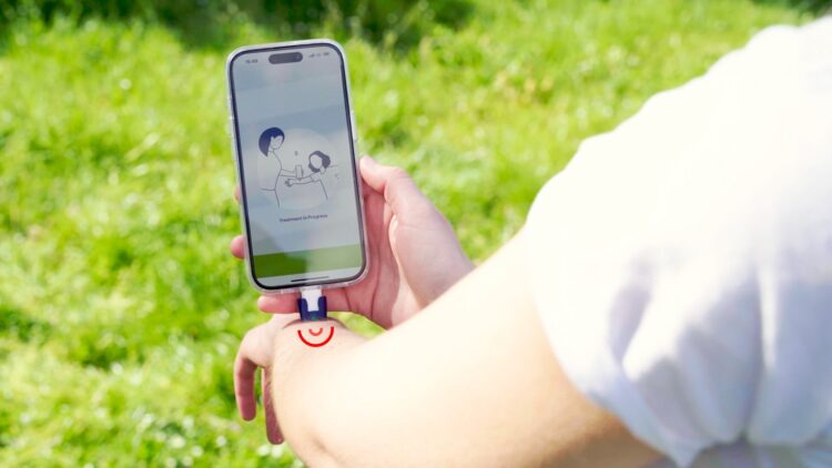 Confirmed by dermatologists - this German mobile phone-connected invention reduces insect itching by 78% in just 10 minutes