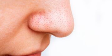 Álex Docampo, dermatologist - “Those blackheads you see on your nose are not acne or dirt, and if you pull them out with strips you only damage your skin”