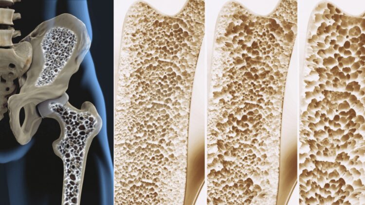 It's official—scientists find the “biological switch” that strengthens bones and could end osteoporosis