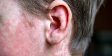 It's official—South Carolina is on health alert after a measles outbreak that has already affected several schools in the state