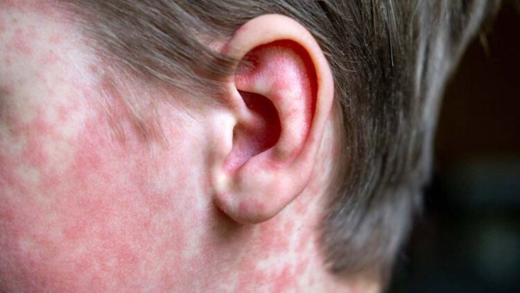 It's official—South Carolina is on health alert after a measles outbreak that has already affected several schools in the state