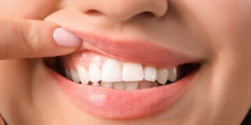 Confirmed—Scientists develop a gel that repairs tooth enamel and could eliminate cavities forever